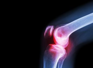 film x ray knee joint with arthritis gout rheumatoid arthritis osteoarthritis knee 1