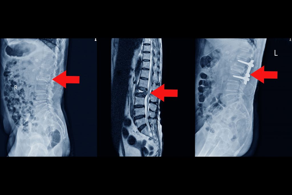 mri lumbar spine history fall with back pain radiate leg rule out spinal stenosis impression burst fracture l2 vertebral body with severe vertebral collapse red point medical concept 1