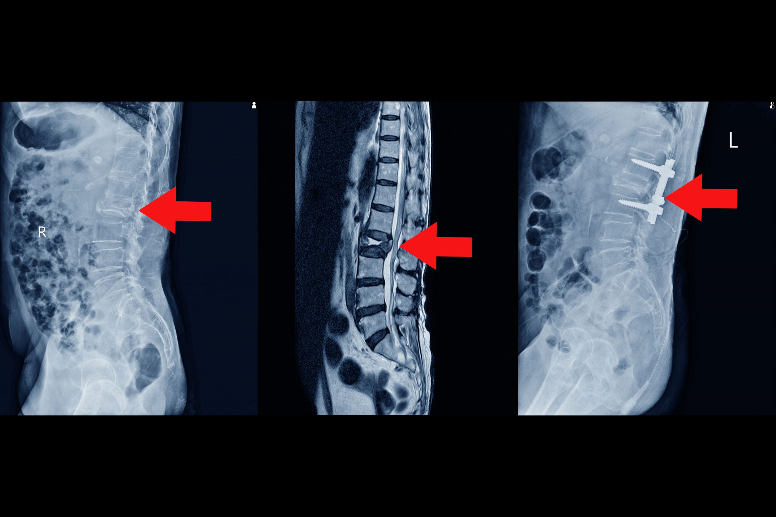 mri lumbar spine history fall with back pain radiate leg rule out spinal stenosis impression burst fracture l2 vertebral body with severe vertebral collapse red point medical concept 1 scaled