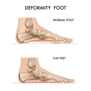 2012.i305.014..realistic bones anatomy foot arch deformation